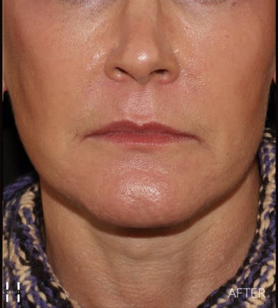 Necklift Before & After Gallery - Patient 426364 - Image 2