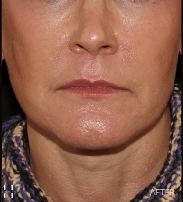 Necklift Before & After Gallery - Patient 426364 - Image 2