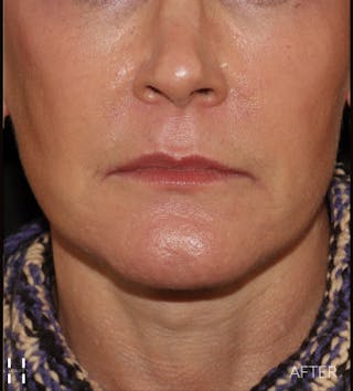Facelift Before & After Gallery - Patient 121670066 - Image 2