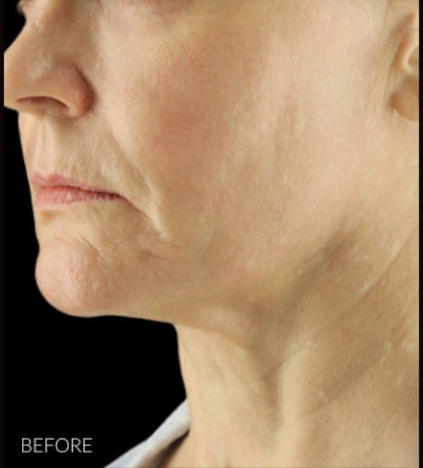 Necklift Before & After Gallery - Patient 426364 - Image 3