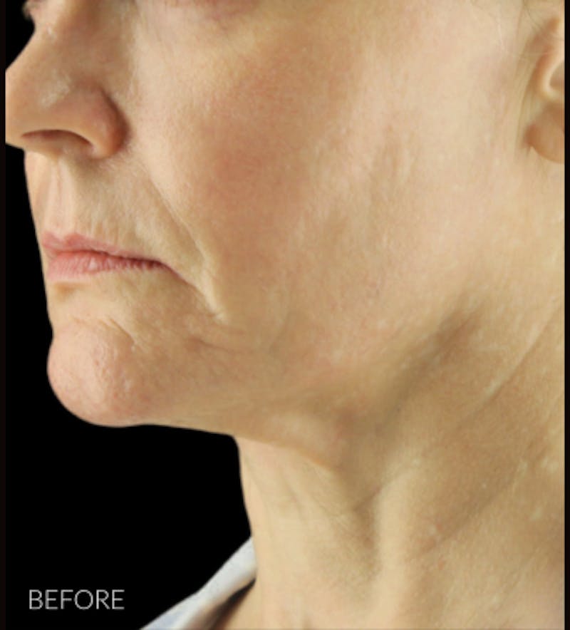 Facelift Before & After Gallery - Patient 121670066 - Image 3
