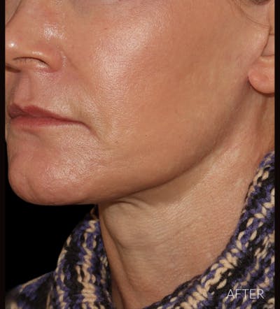 Necklift Before & After Gallery - Patient 426364 - Image 4