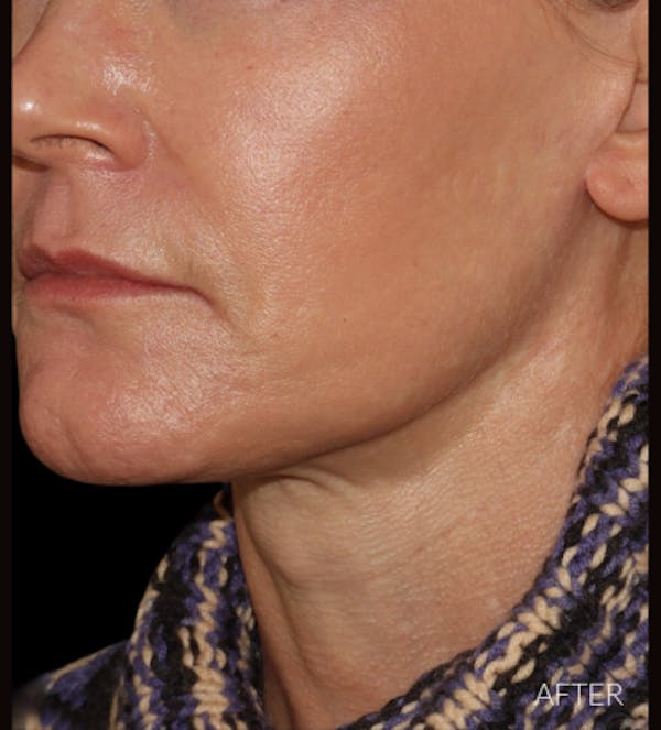 Necklift Before & After Gallery - Patient 426364 - Image 4