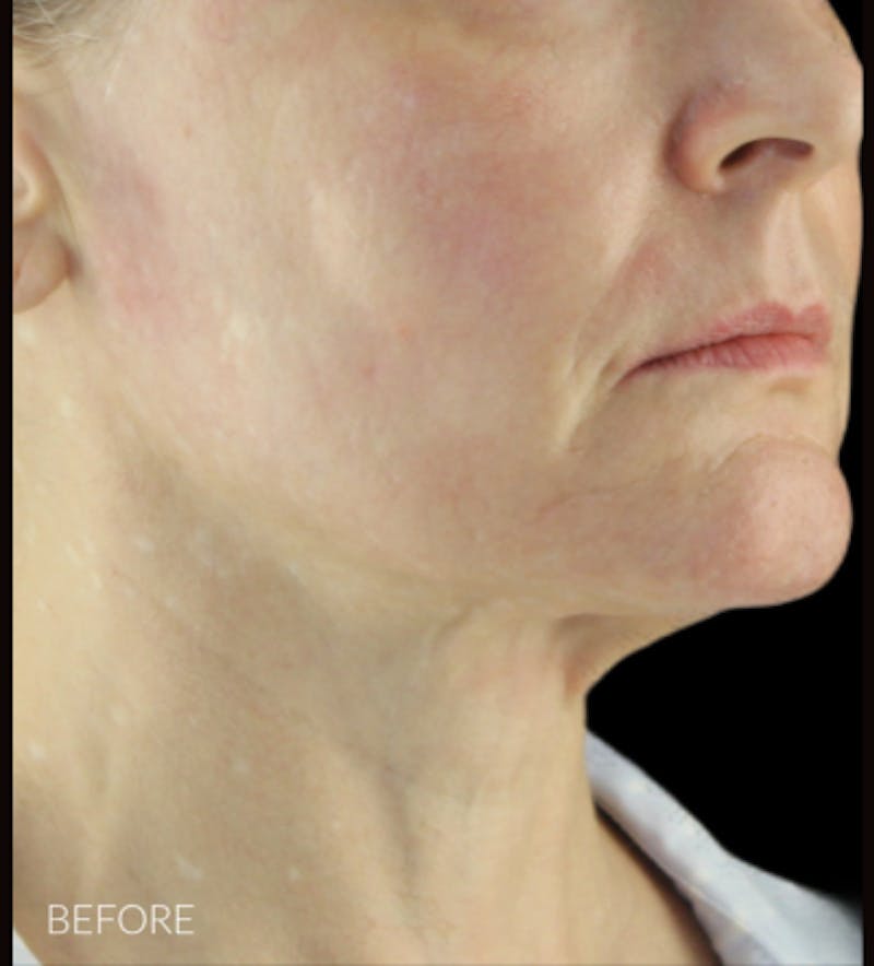Facelift Before & After Gallery - Patient 121670066 - Image 7