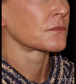 Facelift Before & After Gallery - Patient 121670066 - Image 8