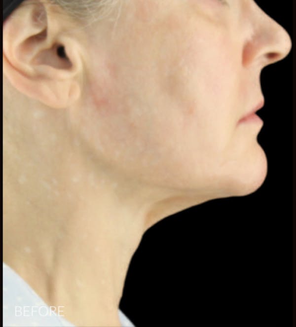 Necklift Before & After Gallery - Patient 426364 - Image 5