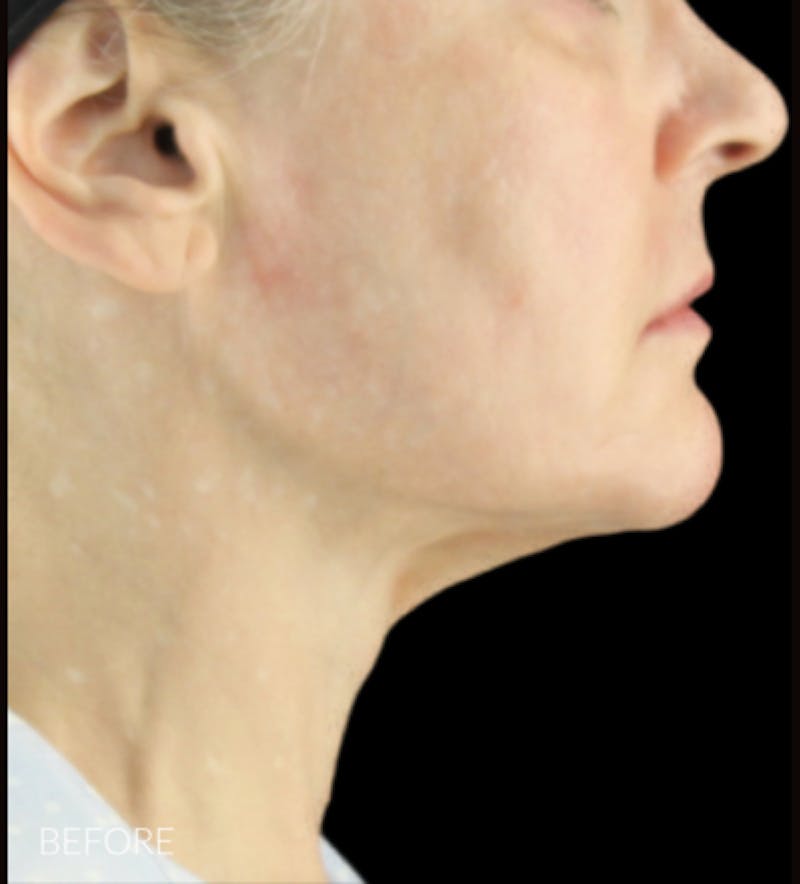Facelift Before & After Gallery - Patient 121670066 - Image 5