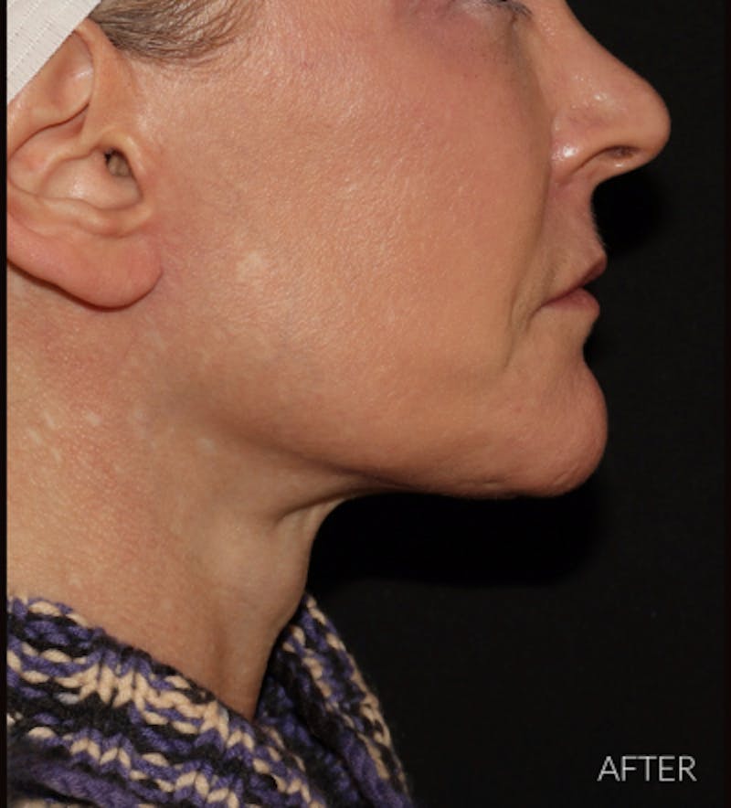 Facelift Before & After Gallery - Patient 121670066 - Image 6
