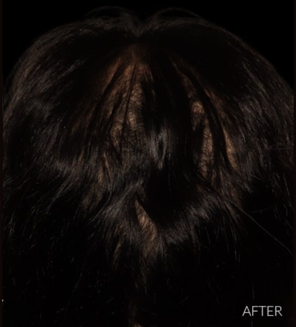Non Surgical Hair Restoration Before & After Gallery - Patient 200727 - Image 4