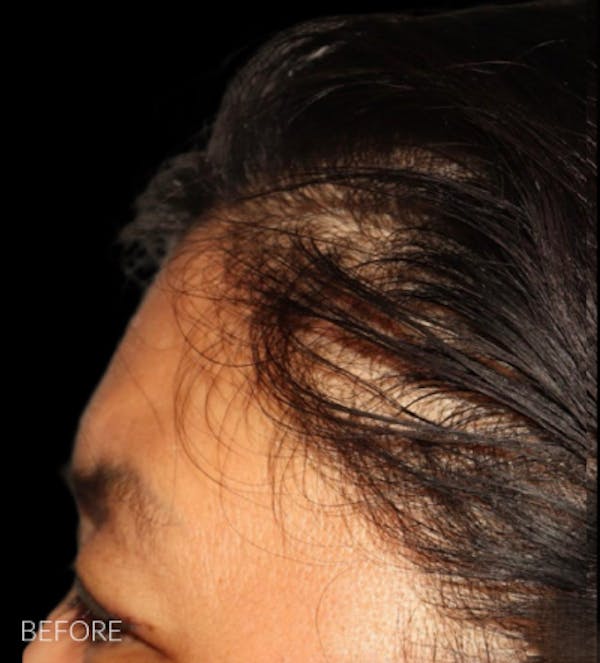 Non Surgical Hair Restoration Before & After Gallery - Patient 200727 - Image 1