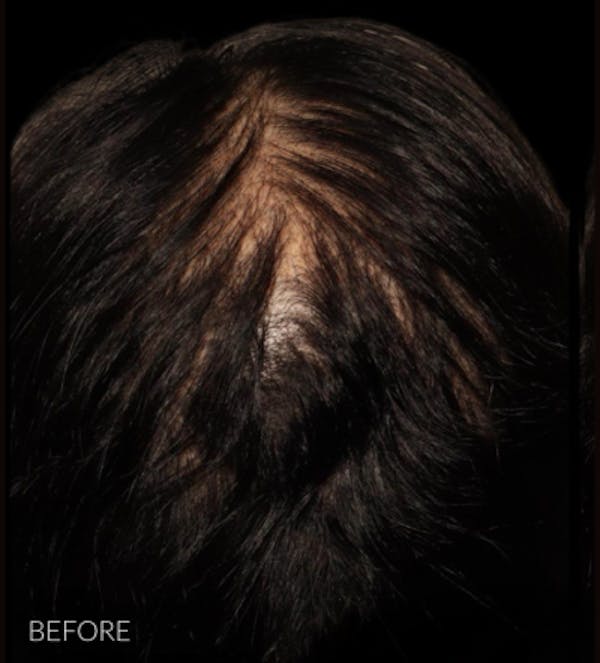 Non Surgical Hair Restoration Before & After Gallery - Patient 200727 - Image 3