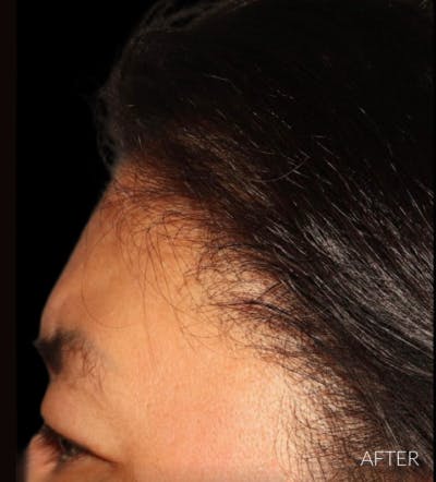 Non Surgical Hair Restoration Before & After Gallery - Patient 200727 - Image 2