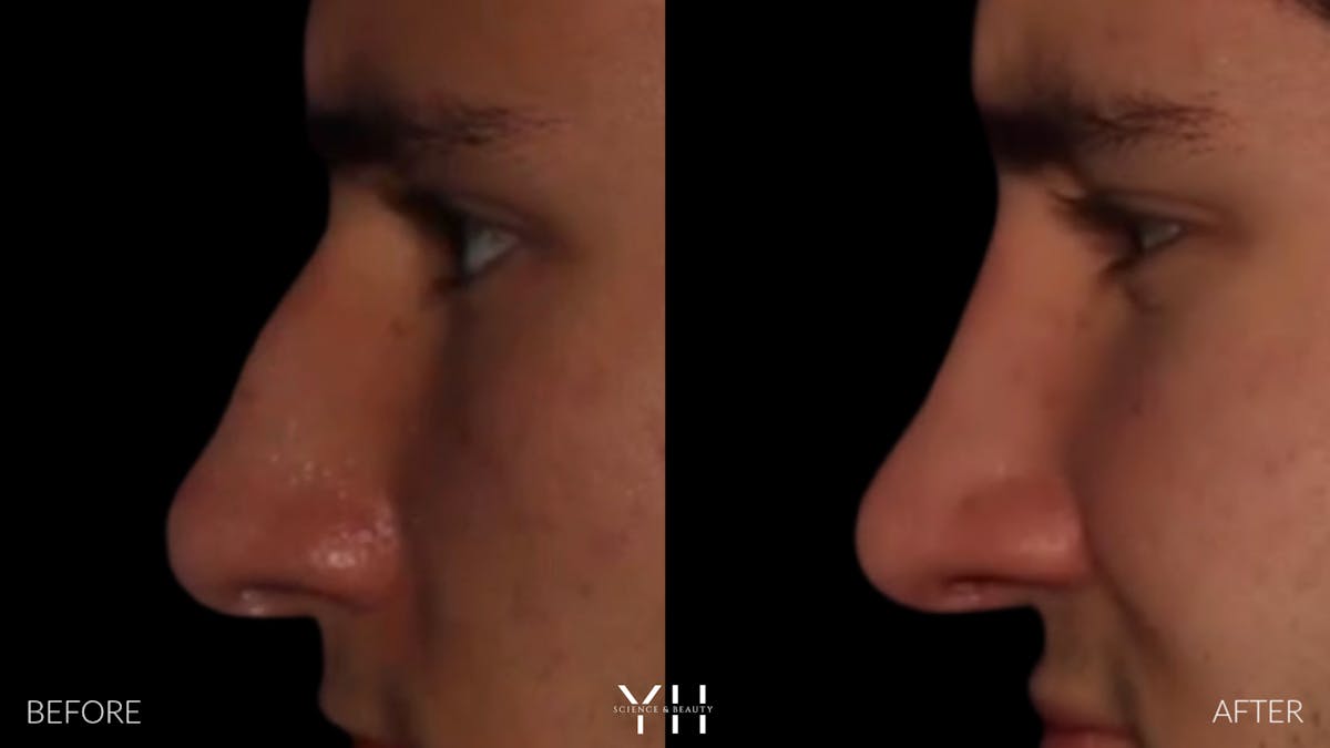 Rhinoplasty Before & After Gallery - Patient 397800 - Image 5