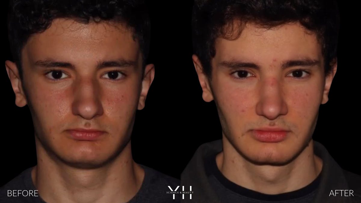 Rhinoplasty Before & After Gallery - Patient 397800 - Image 3