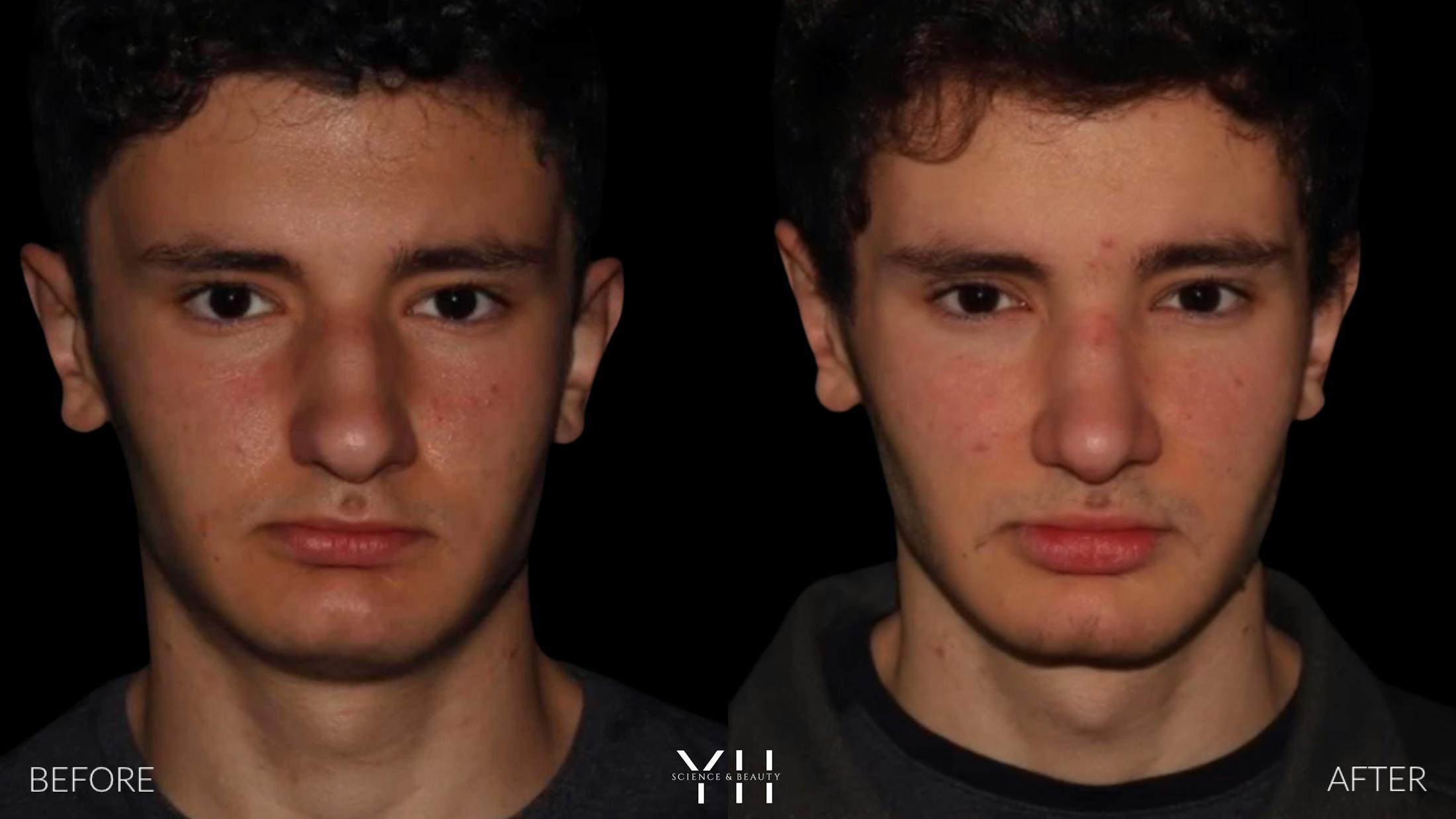 Rhinoplasty Before & After Gallery - Patient 397800 - Image 3