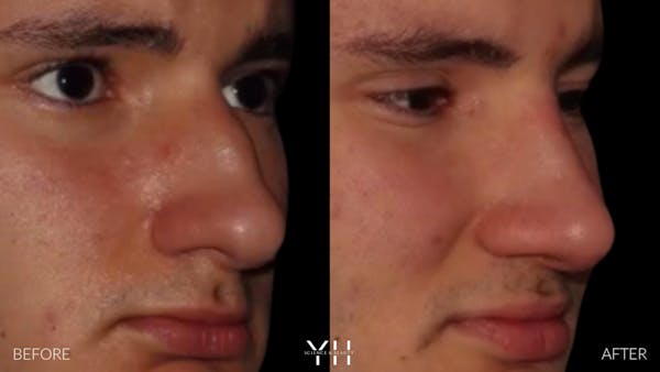 Rhinoplasty Before & After Gallery - Patient 397800 - Image 8