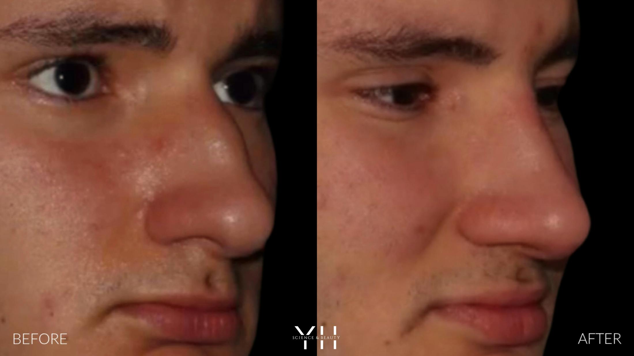 Rhinoplasty Before & After Gallery - Patient 397800 - Image 8