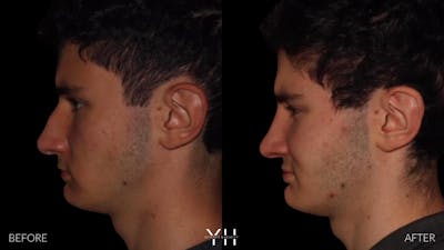 Rhinoplasty Before & After Gallery - Patient 397800 - Image 4
