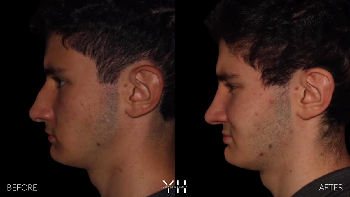 Rhinoplasty Before & After Gallery - Patient 397800 - Image 4