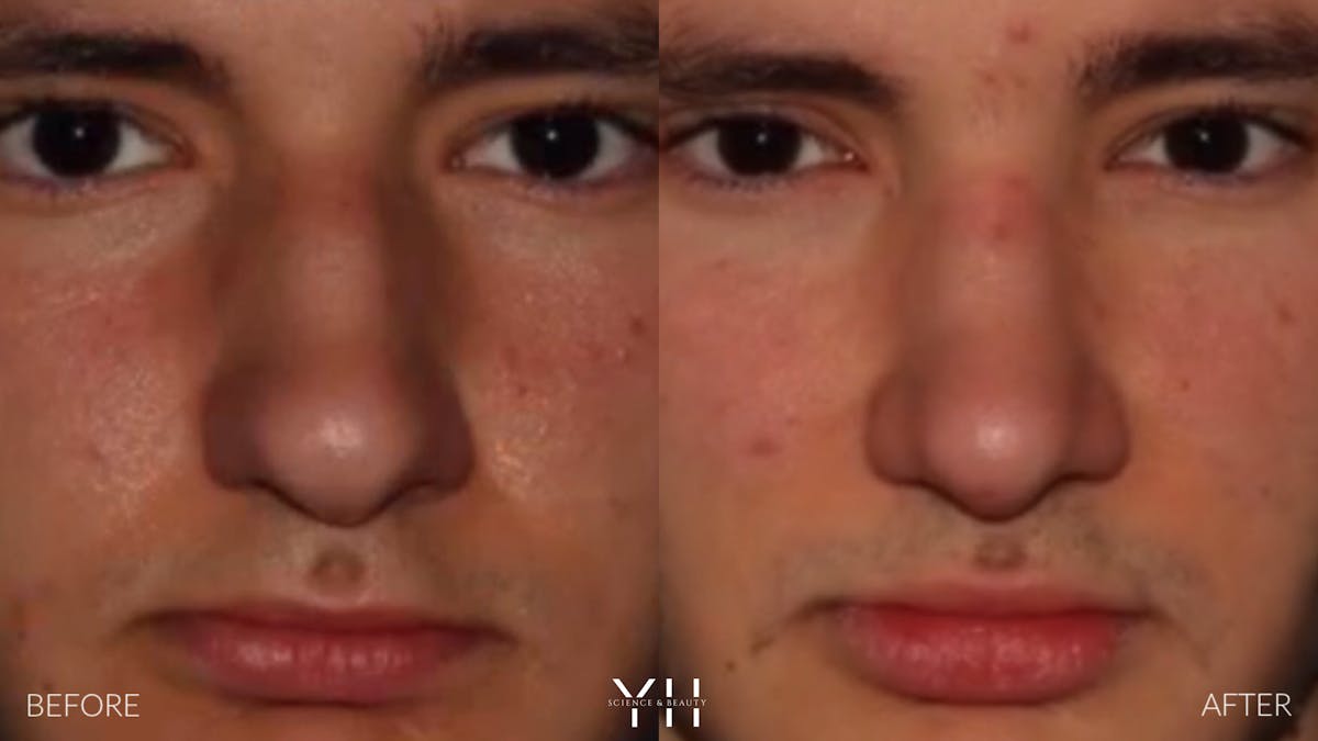 Rhinoplasty Before & After Gallery - Patient 397800 - Image 7