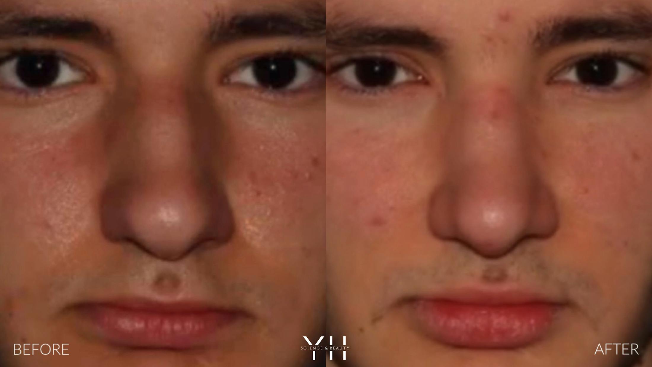 Rhinoplasty Before & After Gallery - Patient 397800 - Image 7