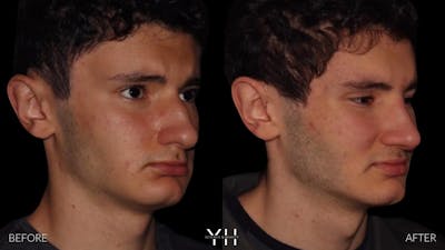 Rhinoplasty Before & After Gallery - Patient 397800 - Image 2