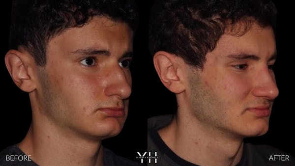 Rhinoplasty Before & After Gallery - Patient 397800 - Image 2