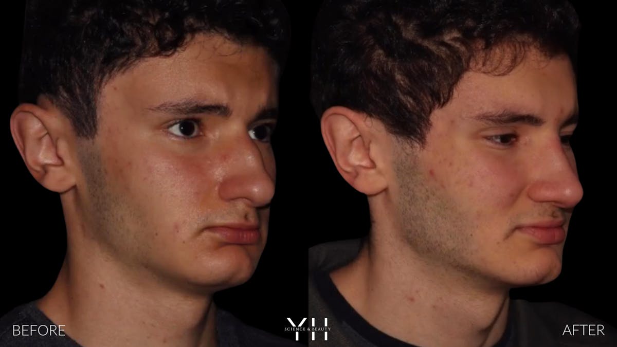 Rhinoplasty Before & After Gallery - Patient 397800 - Image 2