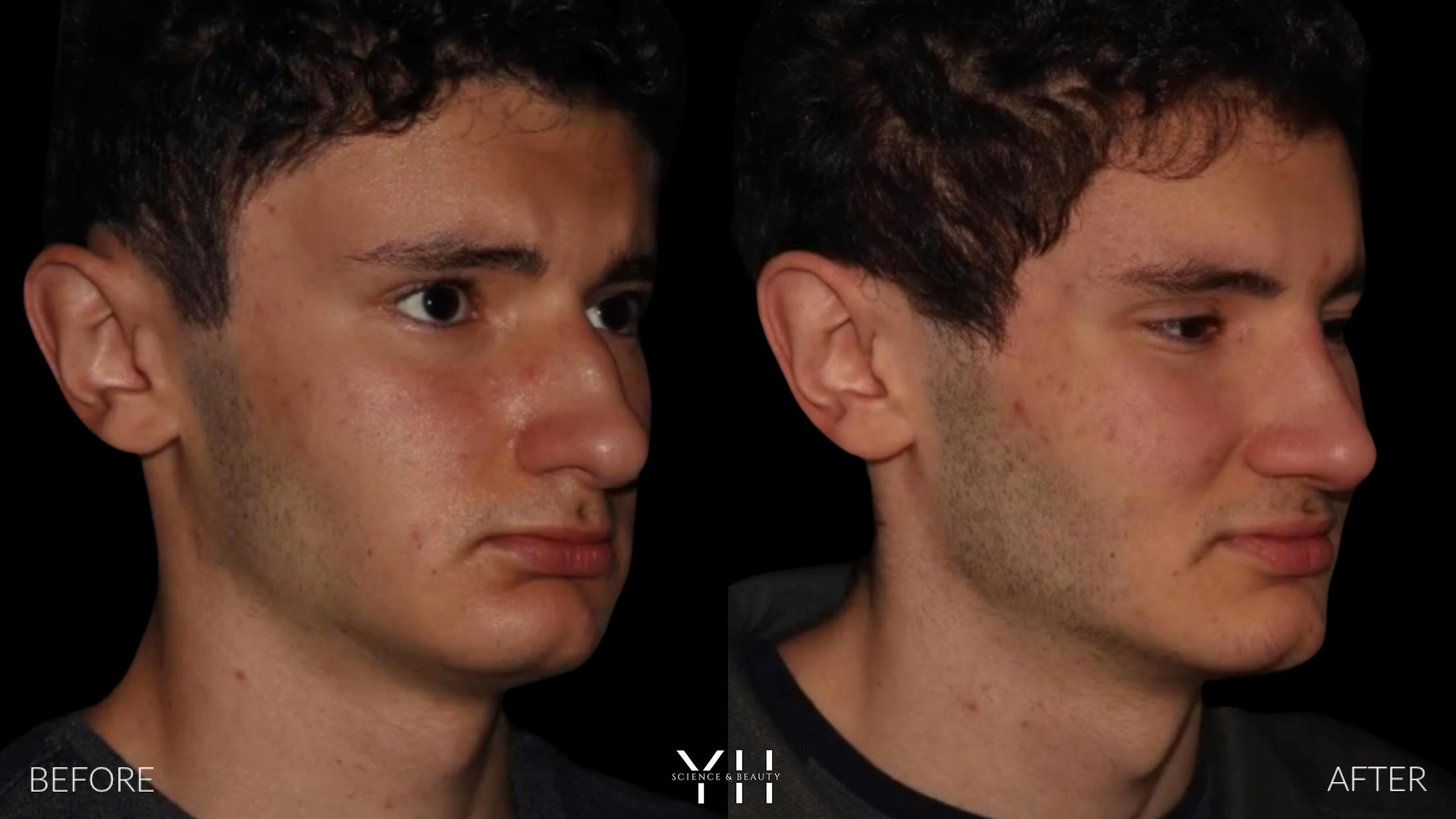 Rhinoplasty Before & After Gallery - Patient 397800 - Image 2