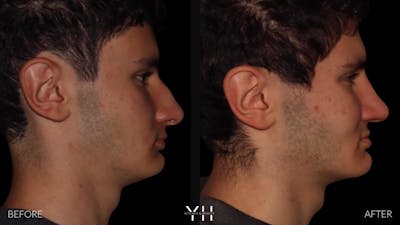 Rhinoplasty Before & After Gallery - Patient 397800 - Image 1