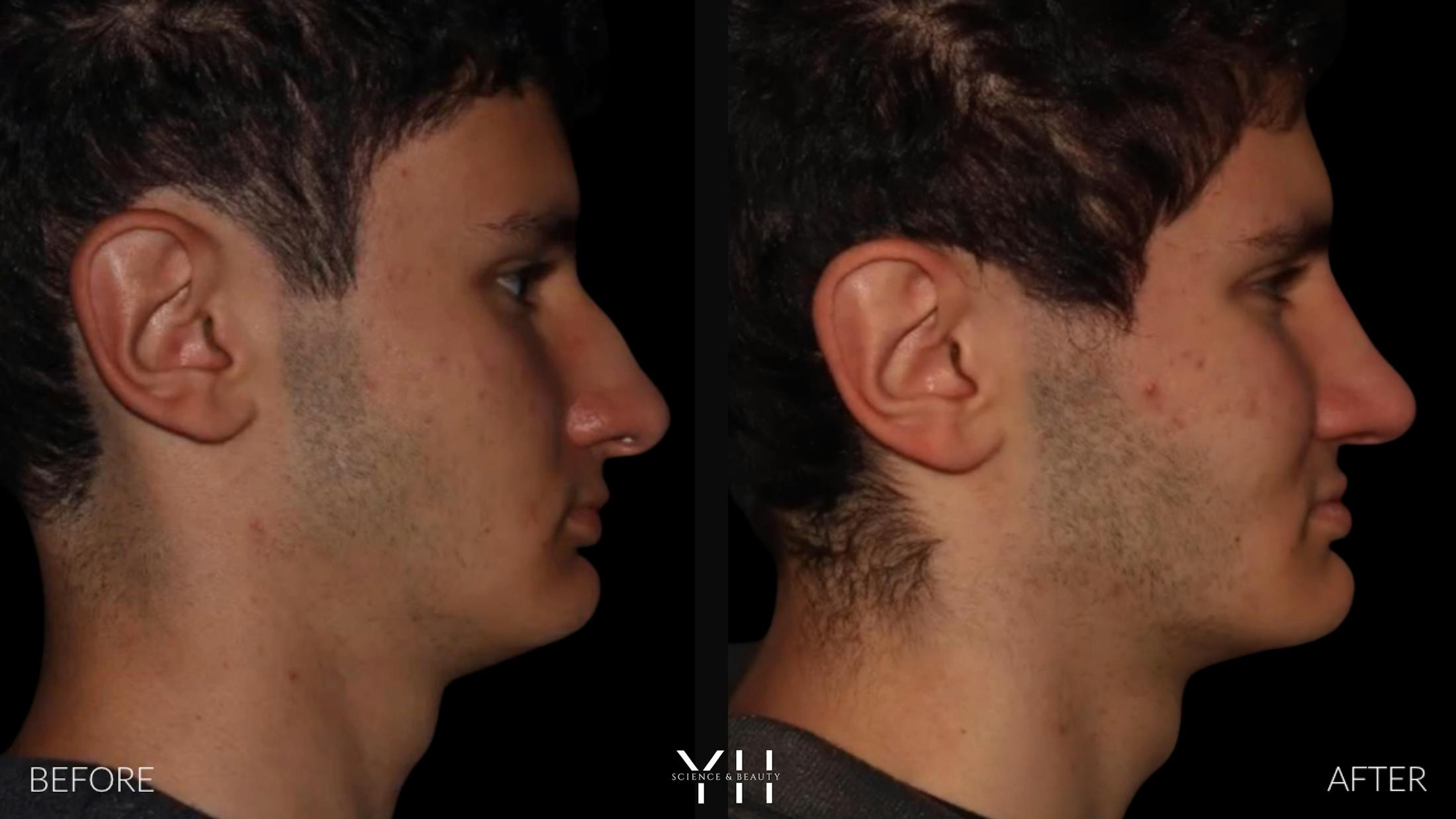Rhinoplasty Before & After Gallery - Patient 397800 - Image 1