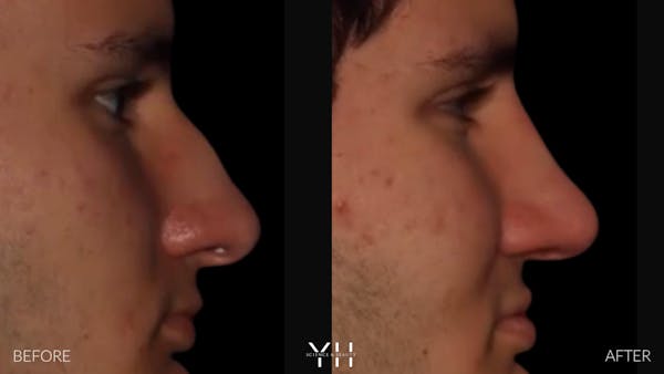 Rhinoplasty Before & After Gallery - Patient 397800 - Image 6
