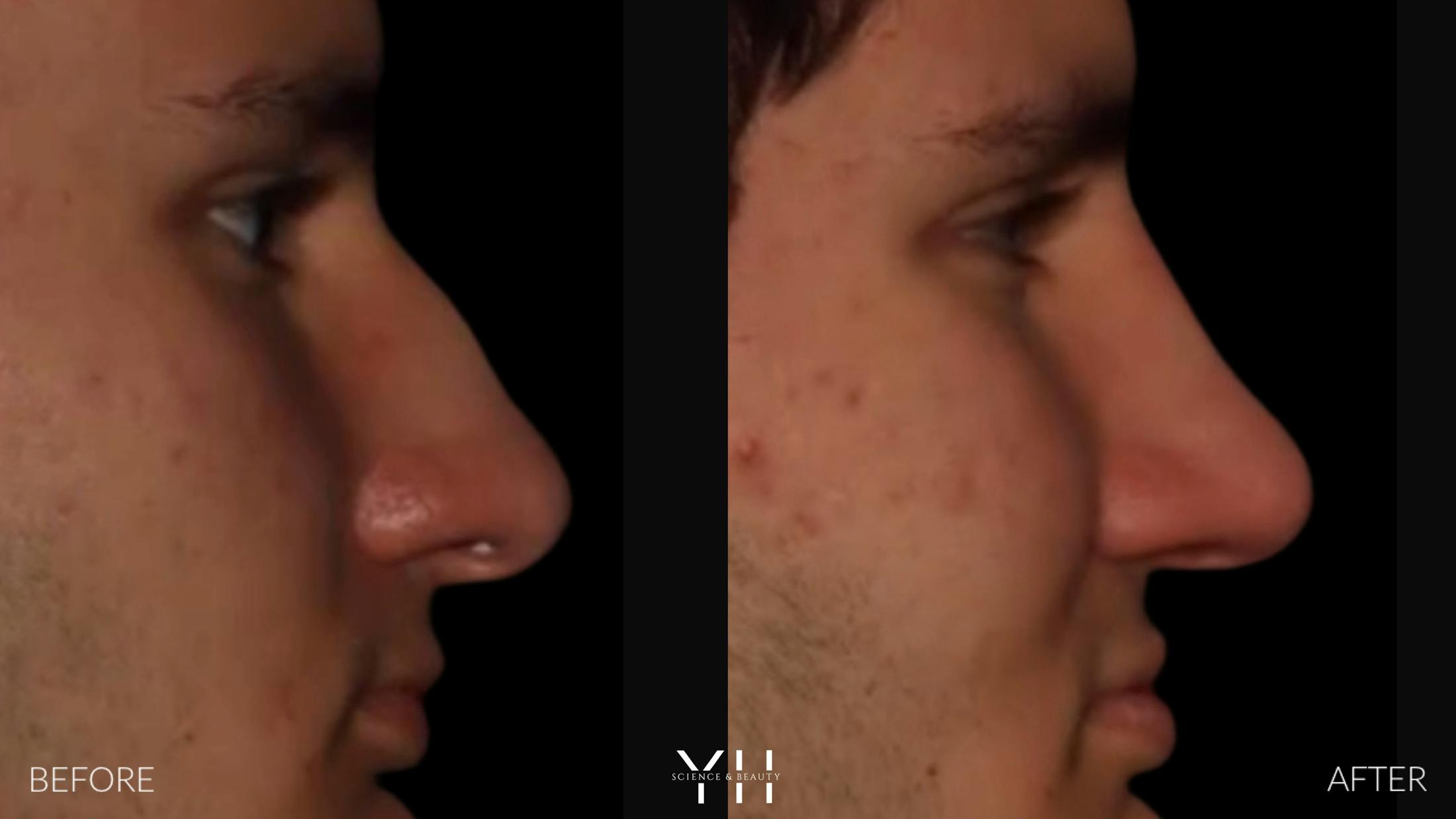 Rhinoplasty Before & After Gallery - Patient 397800 - Image 6