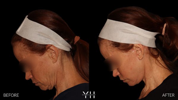 Facelift Before & After Gallery - Patient 117598 - Image 9