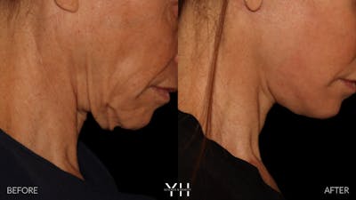 Facelift Before & After Gallery - Patient 117598 - Image 16