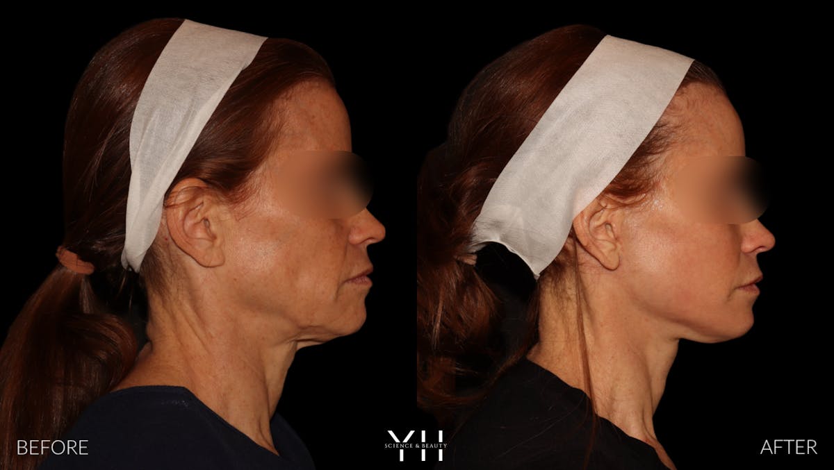 Facelift Before & After Gallery - Patient 117598 - Image 2