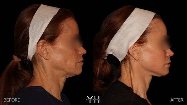 Facelift Before & After Gallery - Patient 117598 - Image 2