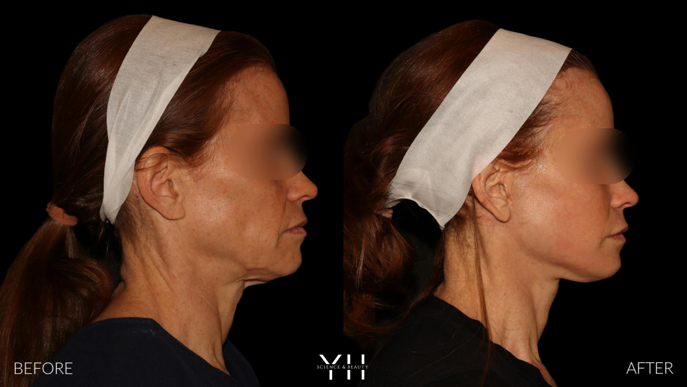 Facelift Before & After Gallery - Patient 117598 - Image 2