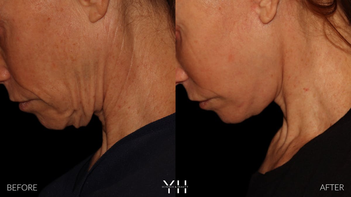 Facelift Before & After Gallery - Patient 117598 - Image 19