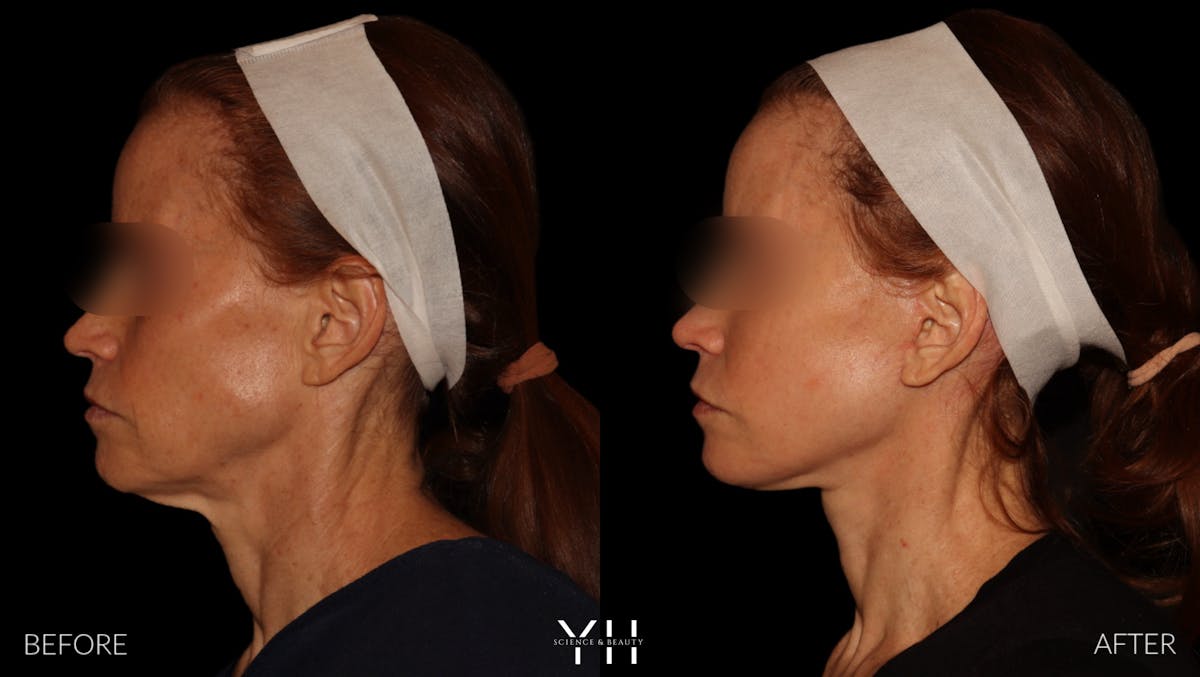 Facelift Before & After Gallery - Patient 117598 - Image 6