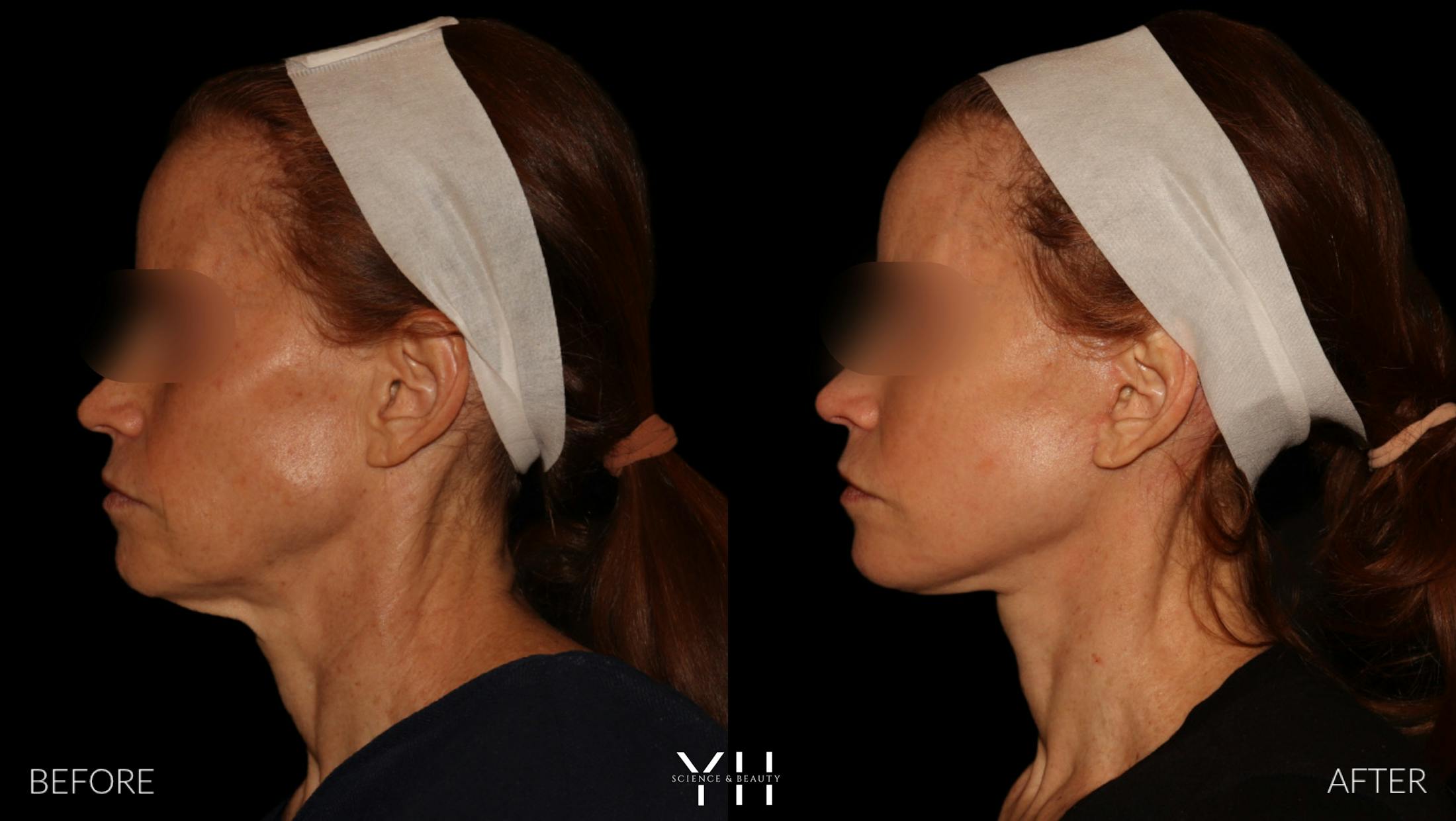 Facelift Before & After Gallery - Patient 117598 - Image 6