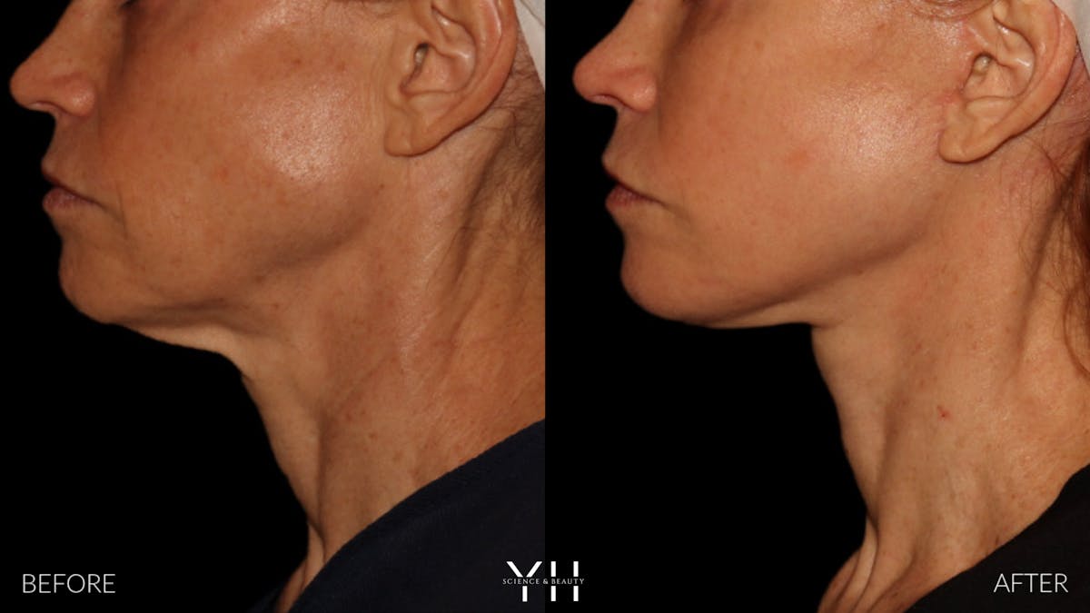 Facelift Before & After Gallery - Patient 117598 - Image 17