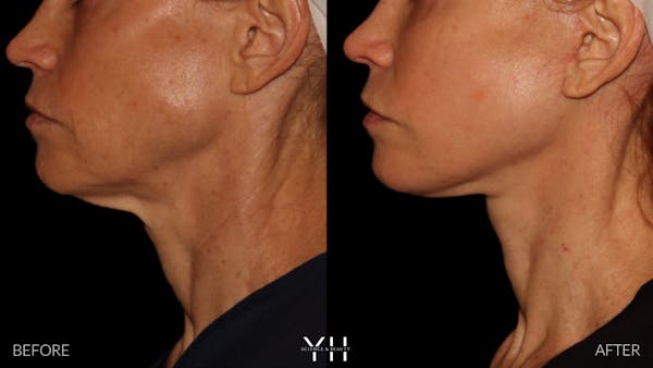 Facelift Before & After Gallery - Patient 117598 - Image 17