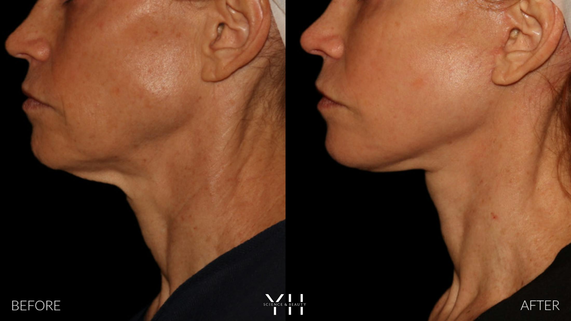Facelift Before & After Gallery - Patient 117598 - Image 17