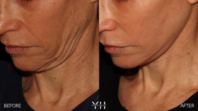 Facelift Before & After Gallery - Patient 117598 - Image 20