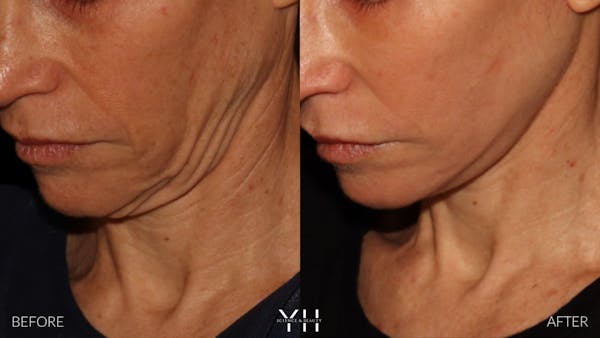 Facelift Before & After Gallery - Patient 117598 - Image 20