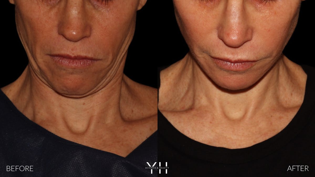 Facelift Before & After Gallery - Patient 117598 - Image 12