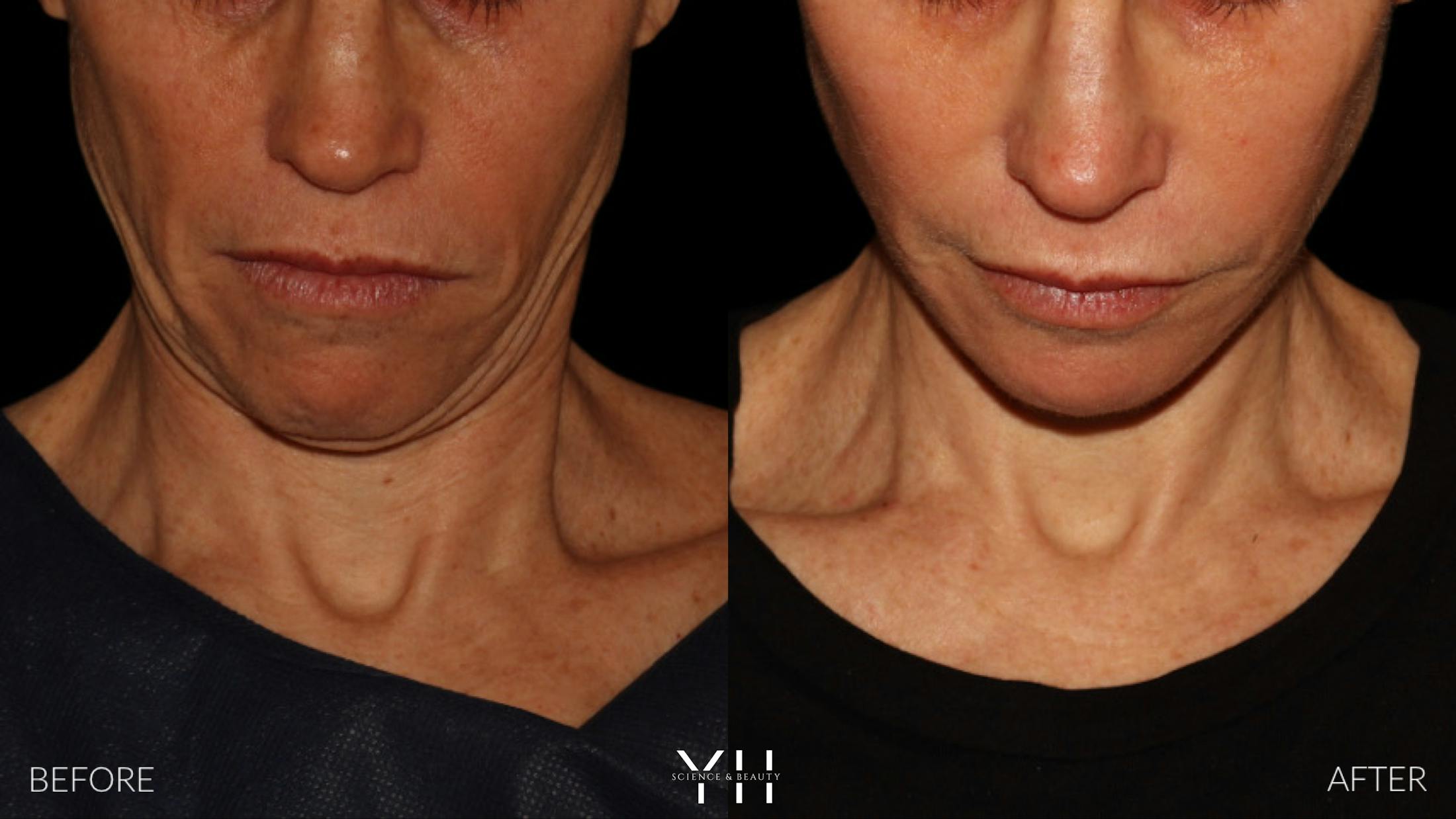 Facelift Before & After Gallery - Patient 117598 - Image 12