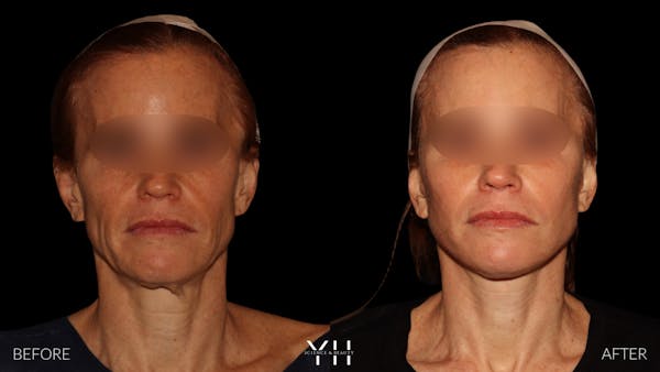 Facelift Before & After Gallery - Patient 117598 - Image 1