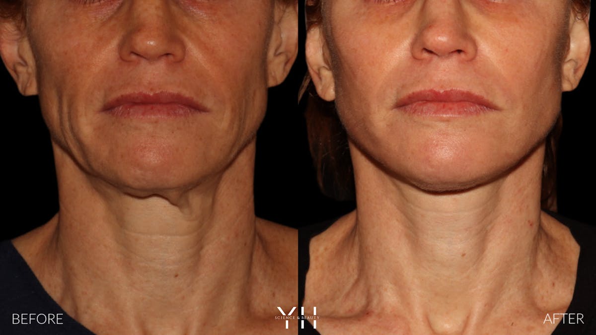 Facelift Before & After Gallery - Patient 117598 - Image 11